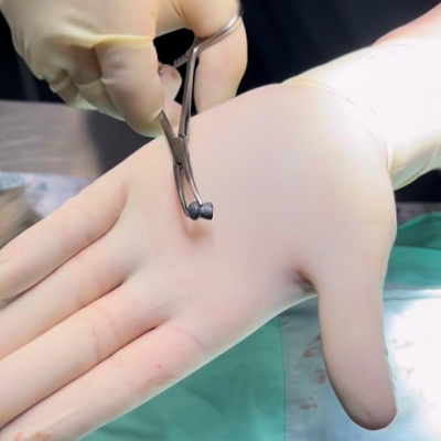 Pellet that had been removed from Poppy the cat being held by a surgical tool over a rubber gloved hand